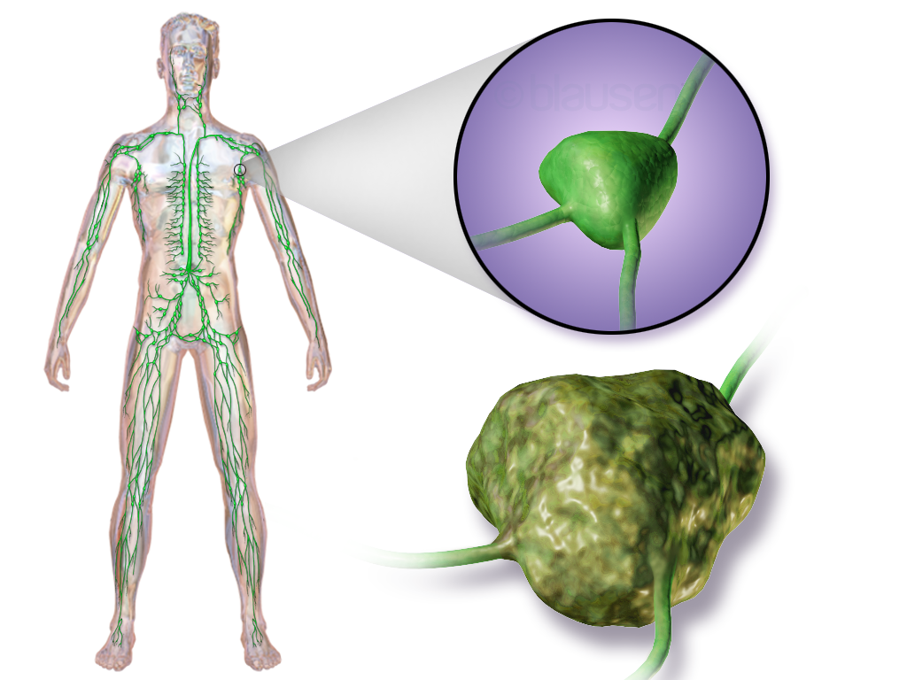 what is lymphoma
